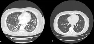 Patient 2. (A) CT scan shows bilateral patchy areas of ground-glass opacities with bronchiectasis at 6 months after started apalutamide. (B) CT scan at 2 months after discontinuing apalutamide, showed practical resolution of the pulmonary signs.