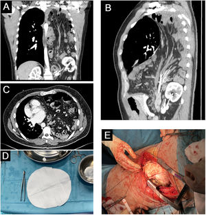 Images A–C belong to the 2023 Computed Tomography (CT) scan in the coronal, sagittal and axial planes, respectively. Herniation of the abdominal viscera into the left hemithorax is evident, with the following sac contents: ventral portion of a pancreas bifidum, left kidney, mesenteric root, transverse colon, ascending colon, cecum, appendix, a major portion of the stomach as well as the angle of Treitz and the entire small intestine. The displacement of the mediastinum toward the right has led to compression of not just the left but also the right lung, which is consistent with the patient's worsening dyspnea. Image D corresponds to the Gore-Tex Dual mesh dynamic patch, 20cm×30cm in diameter, used in this case. Its dimensions were revised again prior to placement to ensure complete coverage of the defect. Image E was taken just moments after the end of the placement of the patch with 11 manually tailored Gore-Tex buttons additionally sutured to provide structural support to the prosthesis.