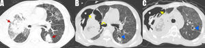Computed tomography of the immunocompromised patient showed diffuse ground-glass densities in both lungs. Red arrows show ground-glass densities, consolidated areas (A). Yellow arrows show pleural rupture. White asterisks indicate the area of subcutaneous emphysema, yellow curved arrow indicate bronchopleural fistula, blue arrowheads indicate different aspergillomas showing the air crescent (B and C).