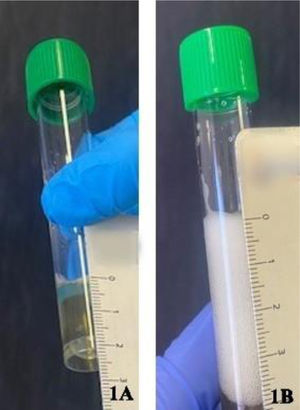 Hydrogen peroxide test 3%. (A) Transudate pleural effusion without bubble. (B) Exudative pleural effusion with presence of air bubbles.
