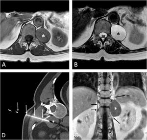 (A and B) Axial T1-weighted (A) and T2-weighted (B) MR images show a well-defined retroperitoneal lesion (asterisk) involving the left crus of the diaphragm. (C) Coronal T1-weighted MR image following the administration of iv contrast confirms the cystic nature of the mass (lack of enhancement) and better shows the relationship of the lesion with the crus of the left hemidiaphragm (long arrows); note the normal appearance of the right crus of the diaphragm (short arrows). (D) Axial CT image (mediastinal window) shows the fine-needle aspiration procedure (arrows) of the lesion (asterisk).
