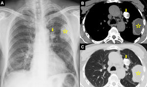 Posteroanterior (PA) chest radiograph (A) shows a perihilar calcified lesion (arrow) and a peripheral radiopaque lesion (star) with smooth margin in the left lung. Thoracic computed tomography mediastinal (B) and parenchymal window axial sections (C) show a 30mm×24mm lesion with diffuse calcification in the anterior segment of the upper lobe of the left lung (arrow) and a 60mm×40mm cystic lesion in the upper lobe apicoposterior segment (asterisk) in the pleural neighborhood.