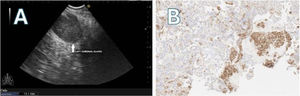 (A) EUS-B: left adrenal mass (tick arrow). (B) EUS-B-FNA of left adrenal gland: PD-L1 expression.