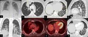 (A) Posteroanterior chest radiograph in erect position, showing patchy partially linear peripheral opacities in the lower zones (blue arrows). Allowing for incomplete inspiratory effort and elevated right hemidiaphragm, the right hilum also appears prominent. (B) CT chest study, axial plane in lung window showing a consolidation in the right upper lobe (yellow arrow) with prominent right hilar lymph nodes. (C) CT chest study, axial plane in lung window showing extensive smooth interlobular serpiginous septal thickening (yellow dashed circles) representing prominent dilated nodular lymphatic channels around the secondary pulmonary lobules in the lower lobes. Note there is no pleural effusion; there was no pleural thickening. (D, E) CT chest study, minimum intensity projection (10mm) in sagittal and coronal views, respectively, highlighting the shape and distribution of lower zone predominant serpiginous septal thickening. (F, G) Fused FDG PET-CT images in axial view show a resolving right upper lobe consolidation of low avidity (yellow arrow), as well as non-avid septal thickening in the lower zones. (H) CT pulmonary angiogram acquired 4 years later for a suspicion of pulmonary embolism, axial view, lung window shows progression of the septal thickening, with maintained shape patterns. There was no pulmonary embolism.