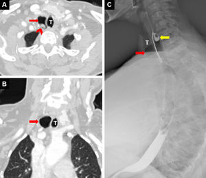 Thoracic computed tomography (CT) axial (A) and coronal (B) section reveals tracheal diverticulum (red arrow) and mucus secretion within the diverticulum (arrowhead). Barium esophagogram (C) reveals esophageal diverticulum proximally (yellow arrow) and anteriorly air from tracheal diverticulum (red arrow). T: trachea.