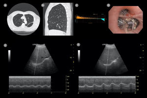 High-resolution CT thorax showing upper lobe predominant heterogeneous emphysema with centrilobular distribution in the right lung (Panel A) and complete fissure integrity (Panel B). Absence of collateral ventilation confirmed by occlusion of the right upper lobe ostium with the Chartis® balloon (Panel C). Deployment of three endobronchial valves in the anterior, posterior, and apical segments of the right upper lobe (Panel D).
