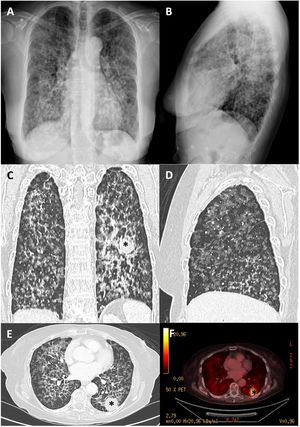 Clinical case images: chest X-ray, computed tomography scan and positron emission tomography/computed tomography. Posteroanterior (A) and lateral (B) chest X-ray with bilateral nodular pattern. Chest computed tomography showing the lung mass (asterisk) in left lower lobe (coronal (C) and axial (E) views) with multiple bilateral ground-glass nodules, with a tendency to cavitation better defined in lower lobes (lateral view (D)). Fluorine-18 fluorodeoxyglucose positron emission tomography (E) with pathologic increased uptake in the mass, with unspecific low generalized metabolic activity.