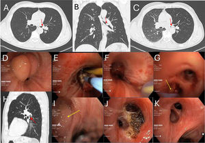 (A and B) Initial chest computed tomography revealing a lesion (red arrow) at the left main bronchial bifurcation; (C) air entrapment observed in the left lung during expiratory phase in chest computed tomography; (D) endoscopic view of the left main bronchus; (E) bronchial repermeabilization process using cryoablation and argon-plasma coagulation by flexible bronchoscopy; (F) endoscopic view of the left main bronchus after endoscopic resection; (G) endoscopic view inside left b6 segment showing a small remaining lesion (yellow arrow) at a b6 subdivision; (H) chest computed tomography follow-up, 1 month after endoscopic resection, identifying a residual endobronchial lesion (red arrow) at the left b6 segment; (I) endoscopic view of left b6 segment showing a growing lesion (yellow arrow), 2 months after endoscopic resection; (J) endoscopic view inside left b6 segment after the second endoscopic treatment; (K) endoscopic view of left b6 segment, 3 months after the first resection.