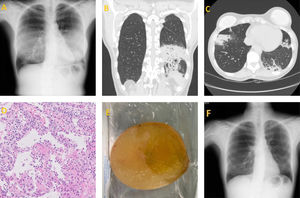 (A) Bilateral lung opacities in both bases are seen in this posteroanterior chest X-ray. (B) Coronal cut of a CT scan showing an infiltrate with air bronchogram suggesting pneumonia in the left lower lobe. (C) Axial cut of a CT scan showing new bilateral patchy consolidations, mainly subpleural, and partial resolution of the ones seen in the previous study. (D) Haematoxylin–eosin staining shows fragments of lung parenchyma with of alveolar septa by acute and chronic polymorphous inflammatory infiltrate, alveolar spaces partially lined by pneumocytes with reactive atypia, predominantly occupied by fibrin and some Masson bodies. (E) Rupture of the breast implant. (F) Resolution of the consolidations in subsequent studies.