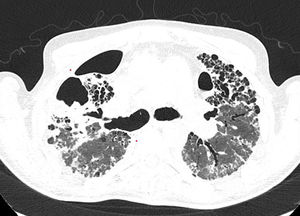 Chest CT scan of the patient before admission.