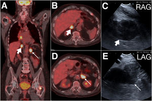 (A) Coronal PET scan: mediastinal mass, right (thick arrow) and left adrenal (thin arrow). (B) and (C) Right adrenal gland (thick arrow) in axial PET scan (B) and EUS-B (C). (D) and (E) Left adrenal gland (thin arrow) in axial PET scan (D) and EUS-B (E).