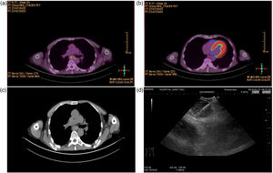 (a) Subcarinal lymphadenopathy on PET/CT; (b) pulmonary nodule on PET/CT; (c) subcarinal lymphadenopathy on CT; (d) cryoEBUS in real-time.