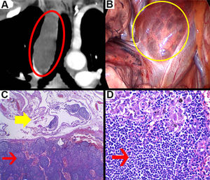 (A) Thoracic coronal CT scan with intravenous contrast show a hypodense mediastinal cyst (red circle) with 9HU. (B) Mediastinal cyst surrounded by the superior vena cava and the right phrenic nerve (yellow circle). (C) Microscopic image ×40, lymphatic follicles (thin red arrow) and vascular structures (thick yellow arrow). (D) Image ×80, lymphatic follicles (thin red arrow).