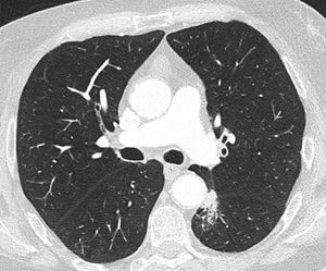 EarlyCDT positive lung adenocarcinoma case from Clinica Universidad de Navarra.