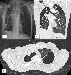 Chest radiograph showed right pneumothorax with pleural thickening (red arrow) (a). CECT Thorax in coronal (b) and axial (c) views revealed tracheal wall defects with direct communication with the pleural cavity, representing tracheopleural fistula (blue arrows). Left upper lobe lung bullae (green arrows) (b, c).