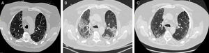 (A) Chest CT, performed 2 weeks before starting certolizumab pegol, showed centrilobular emphysematous changes in the upper lobes and subpleural reticular infiltrates. (B) Chest CT showed emphysema in the upper lobes, subpleural honeycombing, traction bronchiectasis bilateral peripheral ground glass opacities with an organizing pneumonia pattern. (C) A CT of the chest, performed three months after discharge, showed emphysema in the upper lobes and subpleural honeycombing, with resolution of superimposed ground-glass opacities and organizing pneumonia.