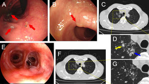 Gastroscopy revealed the presence of multiple ulcers at the gastric angle (A). Colonoscopy showed a polyp in the sigmoid colon (B). Chest CT images revealed pulmonary nodules (yellow arrow) and patchy opacities (blue arrow) in the apical segment of the right upper lobe (C and D). Fiberoptic bronchoscopy with no notable abnormalities (E). Chest CT 3 months after treatment with doxycycline (F and G).