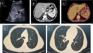 Splenic lesion (A) abdominal ultrasound. (B) Abdominal CT. (C) PET-CT (SUV max 4.9; healthy parenchyma 2.7). (D, E) Chest CT.