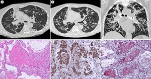 Chest computed tomography at admission (A) and a few days later (B) with coronal reconstruction with maximum intensity projection (C), demonstrating volume loss of the right upper lobe and atelectasis, patchy centrilobular nodules of irregular morphology and peribronchovascular distribution (more evident in C). Detail of “fibrin ball” occupying alveolar space (hematoxylin and eosin, ×10) (D). CD68+ staining in epithelioid histiocytes (E). Masson