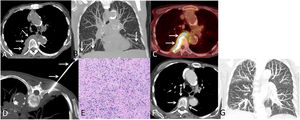 (A) Axial thoracic CT image (mediastinal window) shows a pleural-based perivertebral lesion (arrows). (B) Coronal thoracic CT maximum intensity projection image (lung window) demonstrates bilateral lung nodules (arrows), consistent with metastases. (C) Axial fused PET/CT image shows an FDG-avid pleural-based perivertebral mass (arrows). (D) Axial thoracic CT image (mediastinal window) with the patient in the prone position shows the percutaneous CT-guided biopsy procedure (arrows) of the pleural-based lesion. (E) Histological examination (hematoxylin–eosin staining) shows a spindle cell proliferation with infiltration of lymphocytes and plasma cells. (F) and (G) Follow-up axial (F) (mediastinal window) and coronal (G) maximum intensity projection (lung window) CT images performed 12 weeks after the administration of corticosteroids shows marked improvement of the pleural based lesion (arrows) and resolution of the lung nodules.