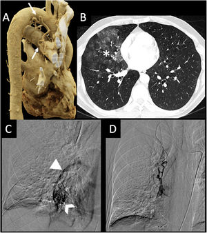 Three-dimensional volumetric reconstruction image of chest CT (A) shows an enlarged ectopic right bronchial artery arising from the undersurface of the aortic arch (arrows). Axial plane pulmonary window CT (B) shows extensive patchy ground-glass opacities in the middle lobe and right lower lobe, consistent with alveolar hemorrhage. Digital subtraction angiography through the right internal mammary artery (C) shows a branch that serves a basal vascular nidus (chevron arrow), which has a direct connection with the respective segmental pulmonary vein (arrowhead). Successful embolization of the lesion was performed (D). These findings are compatible with angiographic findings of bronchial Dieulafoy