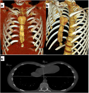 Honeycomb sternum on CT imaging (a, b) and Haller Index measurement (c).