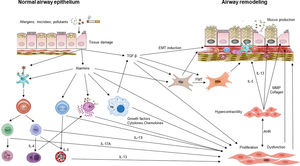 Mechanisms involved in asthma airway remodeling. AHR: airway hyperresponsiveness, ASM: airway smooth muscle, BL: B lymphocyte, DC: dendritic cell, Eo: eosinophil, EMT: epithelial mesenchymal transition, Fbs: fibroblast, FMT: fibroblast–myofibroblast transition, IL: interleukin, ILC2: innate lymphoid cell type 2, Mϕ: macrophage, MC: mast cell, MMP: matrix metallo-proteinase, Mfbs: myofibroblast, Ne: neutrophil, Th2: T helper 2 cell, Th17: T helper 17 cell, TGF-β: transforming growth factor beta.