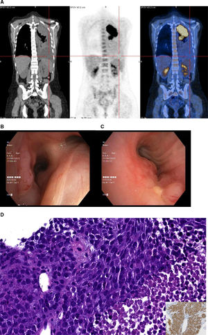 (A) PET-CT scan depicting a large mass in the left upper lobe with extension to the mediastinal region and to the ipsilateral broncho-hilar region, as well as left pleural effusion. (B, C) Videobronchofibroscopy images: (B) Vegetant mass in the anterior traqueal wall, (C) Complete obstruction of left main broncus, (D) Pathological samples: H&E, ×40: Histological examination showed a highly cellular solid neoplasm, with sheets and nests of small to intermediate-sized undifferentiated cells with a monomorphic appearance; apoptosis and mitosis are seen; necrosis is frequent. Inset: NUT IHQ showing a diffuse granular nuclear positivity.