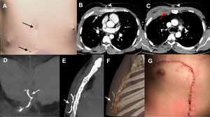 (A) 3D CT reconstruction image of the patient