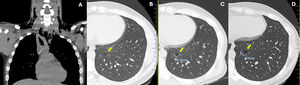 (A) Thoracic computerized tomography scan (coronal view) showing pneumomediastinum and subcutaneous emphysema; (B–D) Thoracic computerized tomography scans showing a cyst in the lower left lobe (yellow arrows), performed eight months before pneumomediastinum (B), during the pneumomediastinum episode (C) and eight months after (D).