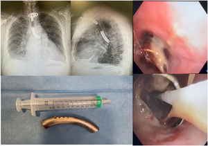 Foreign body in the left main bronchus. Fogarty balloon extraction.