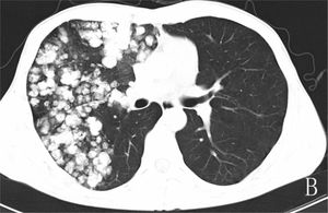 CT scan reveals numerous round nodules of varying sizes and densities with “popcorn calcification” shape, diffusely distributed primarily in the upper and middle lobes of the right lung.