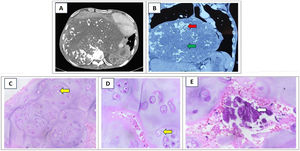 CT thorax (A and B – coronal section) showing a large heterogenous lung mass in the right hemithorax with focal areas of calcification (red arrow) and necrosis (green arrow), shifting mediastinum to the left. USG guided biopsy of the lung mass was done and the HE-stained images showed the chondrocytes arranged in small clusters, and singly in a lacuna (yellow arrows). There is moderate increase in cellularity with multinucleation, and mild atypia (C – 20×; D – 40×). Image E (40×) shows areas of calcification within the tumour (white arrow).