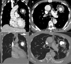 Enhanced coronal (A) and axial (B) computed tomography images showing an inhomogeneous round opacity in the left upper lobe, with a nodular formation showing intense contrast uptake inside, compatible with Rasmussen