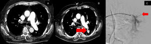 A – demonstrates a CT image pre-thrombectomy without a pulmonary pseudoaneurysm. B – displays a CT image revealing a new heterogeneously hyperdense structure in the superior left lower lobe measuring up to 1.9cm×2.9cm, which appears to demonstrate connection to a left lower lobe segmental pulmonary artery concerning for a pulmonary pseudoaneurysm. C – pulmonary angiography with embolization of superior left lower lobe segmental pulmonary artery with coil.