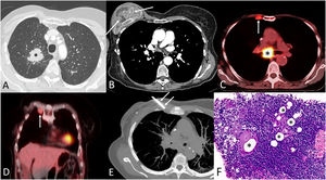 (A) Thoracic axial CT image (lung window) shows a right upper lobe mass (asterisk). (B) Thoracic axial CT image (mediastinal window) performed 8 years earlier shows a ruptured right breast implant (arrows). (C and D) Axial (C) and coronal (D) chest fused PET/CT images show an enlarged FDG-avid right internal mammary lymph node (arrow); note an enlarged subcarinal lymph node (asterisk). (E) Thoracic axial CT maximum intensity projection image shows the core needle biopsy procedure targeting the right internal mammary lymphadenopathy (arrows). (F) Histological examination (hematoxylin–eosin staining; H&E, 20×) demonstrated silicone vacuoles (asterisks) and signs of foreign-body giant-cell reaction.