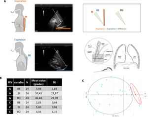 (A) Graphic representation of θ angle and its acquision. Different phases: inspiratory (θI), expiratory (θE) and the difference between them (θD). (B) Main data: Mean measures for each phase of the angle and standard deviation of data collected in assisted (A) and controlled cycles (C). We recorded 3 times each angle for each patient (N=8) MV (mechanical ventilation) SD (standard deviation). (C) Principal Component Analysis (PCA). The data of all the variables are grouped into small values in a situation of CMV and large values in AMV. D=1, p-value=4.122e−09.