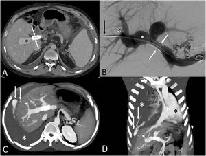 (A) Axial CT image obtained before the PTHPVA shows a portal vein stent (arrows) and a poststent portal vein dilatation (asterisk). (B) Digital subtraction angiogram shows the portal vein stent (arrows) and the poststent right portal vein dilatation (asterisk). (C) Axial maximum intensity projection (MIP) CT image performed after the PTHPVA procedure shows signs of an active bleeding (arrows) originating in the right hemidiaphragm. Note the presence of a right pleural effusion (asterisk). (D) Coronal MIP CT image shows signs of an active bleeding within the pleural space (arrows). Note the presence of a large right pleural effusion (white asterisk) causing a contralateral mediastinal shift (black asterisk).