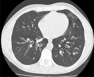 Computed tomography where dilations of bronchial caliber are observed that exceed the diameter of the accompanying vessel in each case, compatible with bilateral cylindrical bronchiectasis and bilateral budding tree pattern.