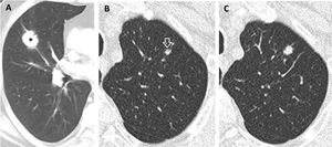 (A–C). Prevalent and pseudo-incidental screen-detected LC at baseline LDCT. Stage IA adenocarcinoma in a 60-year-old man from ITALUNG (A) appearing at baseline LDCT as a large (26mm in mean diameter) solid nodule in the right upper lobe (*). Pseudo-incidental stage IA squamous cell carcinoma in a 67-year-old man from ITALUNG (B and C) appearing at baseline LDCT (B) as an infra-threshold (5.2mm in mean diameter) solid nodule in the left anterior lobe (white empty arrowhead) and showing growth (10mm in mean diameter) at the first annual repeat (C).