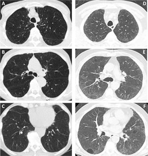 (A–F) Diffuse lung disease at baseline LDCT. Advanced destructive pulmonary emphysema (A–C) in a 65-year-old man from NLST who died of respiratory disease (ICD code J449) 835 days after randomization. Interstitial lung disease (D–F) in a 73-year-old man from NLST who died of respiratory disease (ICD code J849 – interstitial pulmonary disease unspecified) 2462 days after randomization.