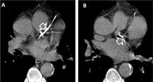 (A and B). Coronary artery calcifications at baseline LDCT. Severe coronary artery calcifications in the anterior interventricular artery (white empty arrowhead A) and left circumflex artery (white empty arrowhead B) at baseline LDCT in a 69-year-old man from NLST who died of atherosclerotic heart disease (ICD code I251) 226 days after randomization.