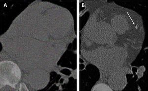 (A and B) Assessment of risk of CV disease based on the analysis of baseline LDCT with Chao et al. deep learning algorithm.98 The algorithm attributes a moderate (score=0.351) CV risk in a 55-year-old man from NLST who did not show any coronary artery calcification at baseline LDCT (A) and who died of ischemic heart disease (ICD code I250) 2004 days after randomization. The algorithm attributes a high (score=0.700) CV risk in a 70-year-old woman from NLST with mild coronary artery calcifications (white arrow) at baseline LDCT (C) and who died of acute myocardial infarct (ICD code I219) 511 days after randomization.