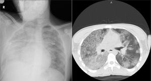 Thorax-CT showing bilateral diffuse ground glass opacities.