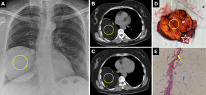 Posteroanterior chest radiograph (A) and thorax computed tomography axial sections (B, C) show a 110mm×105mm×100mm, well-circumscribed, intraparenchymal lesion with fat density in the right lower lobe (circle). Macroscopic structure of lung tissue (D) after lower lobectomy and angiofibrolipoma (circle) and lung tissue (asterisk) after excision of the intraparenchymal lesion are shown. A benign mesenchymal neoplasm comprising mature adipocytes (blue arrow), capillary vascular vessels (red arrow) and fibrocytes (yellow arrow), separated from the lung by a smooth fibrous capsule, is observed in the lung neighborhood (E).