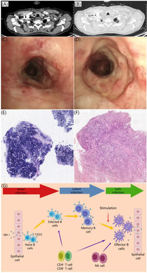 (A and B) Enhanced CT scan of the chest reveals irregular tracheal wall. (C and D) There are protruding lesion and circumferential ulcer lesion in the main trachea that merge together. This merging has led to stenosis of the main trachea. Additionally, there is a large amount of pus coating on the surface. (E) Positive for EBER. (F) Diagnosed as diffuse large B-cell lymphoma. (G) Illustrates the initial infection of EBV.