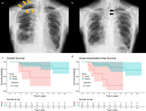 (a) Chest radiograph of a patient with PPFE at discharge, showing residual air space around the lung apex (arrows). (b) Chest radiograph of the same patient taken 1 month after surgical lung biopsy, showing a mediastinal shift toward the operative side (arrows). (c) Kaplan–Meier survival curves for the overall survival of patients grouped by diagnosis. P=0.03 by the log-rank test. (d) Kaplan–Meier survival curves for the acute exacerbation-free survival of patients grouped by diagnosis. P<0.01 by the log-rank test. Overall survival was defined as the number of days from surgical lung biopsy to death due to any cause or the last follow-up. Acute exacerbation-free survival was defined as the number of days from surgical lung biopsy to the diagnosis of acute exacerbation, death due to any cause, or last follow-up. The final follow-up was conducted in March 2024 to evaluate acute exacerbation, pneumothorax, and survival outcomes. Abbreviation: PPFE, pleuroparenchymal fibroelastosis.