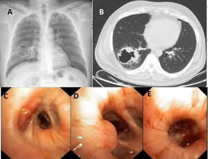 Cavitary lesion in the right lower lobe on thoracic CT (a); endobronchial lesion on the CT scan (b); mass at the entrance of the right middle lobe, narrowing the middle lobe entrance by 80% and protruding into the intermediate bronchus (c); mucosal bulge observed on the lateral wall at the entrance of the basal segment (d); active hemorrhage noted in the laterobasal segment (e).