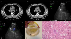 Chest CT (A and B), cryobiopsy performed with endobronchial ultrasound (EBUS) (C and D), cryobiopsy sample (E) and microscopic image (F).