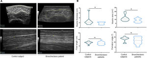 (A) Axial plane (upper panel) and sagittal longitudinal axis (bottom panel) ultrasound images of VL muscle. Muscle area was measured using a yellow line on ultrasound. Left panels show a normal muscle volume, thickness and ultrasound pattern. Right panels show a reduced muscle volume and thickness (hypotrophy). (B) Violin plots with median (dashed line), first and third quartiles (dotted lines) and maximum and minimum values of muscle thickness, fiber length, area and pennation angle absolute values by ultrasound in control subjects and bronchiectasis patients. Definition of abbreviations: VL, vastus lateralis; cm, centimeter; ns, not significant. Statistical significance: *p<0.05.